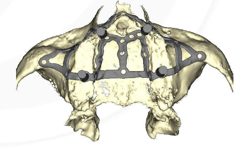 impiantologia odontoiatria tradizionale - impianto iuxtaosseo